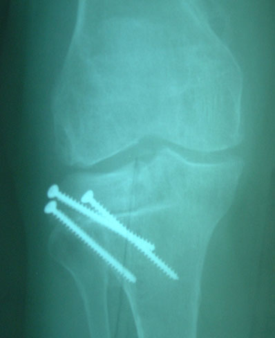 the-knee-diaries-rejection-of-osteochondral-allograft