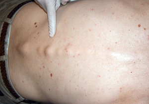 ankylosing-spodylitis