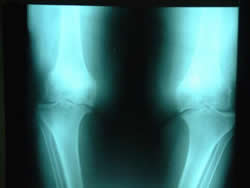 knee-diaries-obesity-remains-as-one-of-the-leading-causes-of-knee-pain