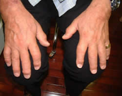 fingers-arthritis