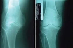 knee-diaries-advanced-osteoarthritis
